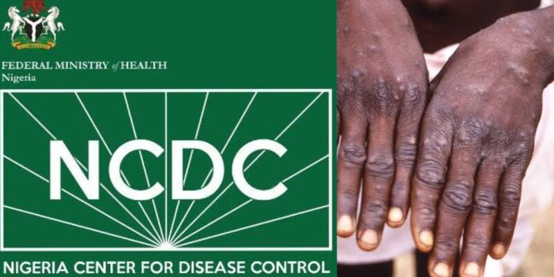 Monkeypox cases rise to 157 in Nigeria