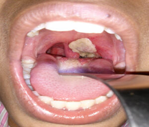 Diphtheria-Kills-600-In-19-States-NPHCDA-Recommends-Face-Mask