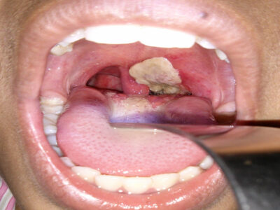 Diphtheria-Kills-600-In-19-States-NPHCDA-Recommends-Face-Mask